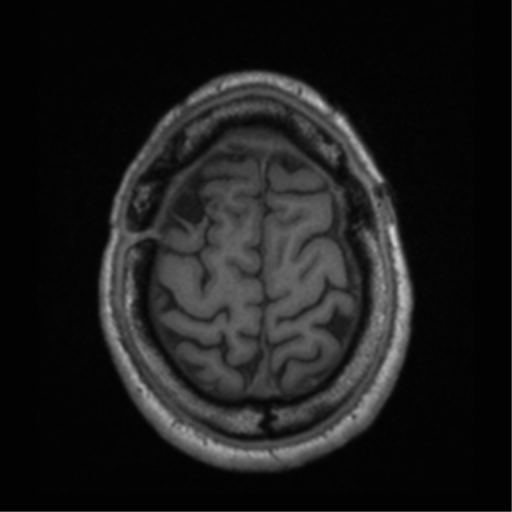 Cerebral hemorrhagic contusions- temporal evolution (Radiopaedia 40224-42757 Axial T1 67).png