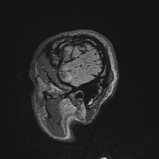 File:Cerebral hemorrhagic contusions- temporal evolution (Radiopaedia 40224-42757 Sagittal T1 72).png
