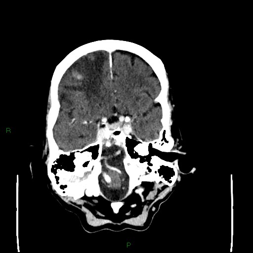 File:Cerebral metastases - breast primary (Radiopaedia 77653-89857 Axial C+ delayed 32).jpg