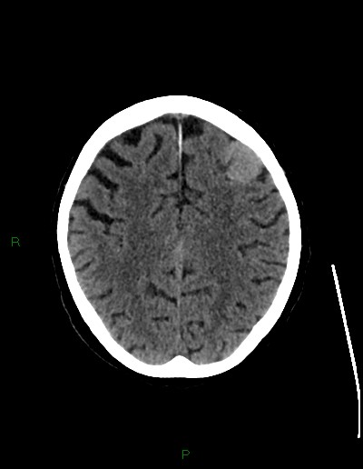 File:Cerebral metastases - ependymal and parenchymal (Radiopaedia 79877-93131 Axial non-contrast 56).jpg