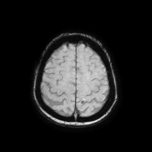 Cerebral metastases - melanoma (Radiopaedia 80972-94522 Axial SWI 80).jpg