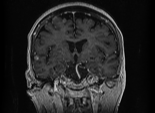 Cerebral metastases from lung cancer with amyloid angiopathy and cerebellopontine angle meningioma (Radiopaedia 74306-85191 Coronal T1 C+ 27).jpg