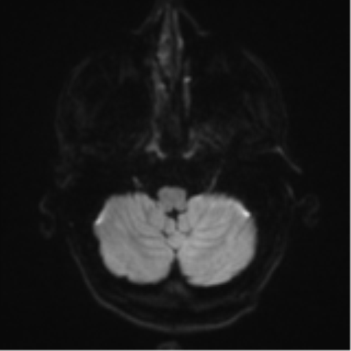 Cerebral metastasis - melanoma (Radiopaedia 54718-60954 Axial DWI 36).png