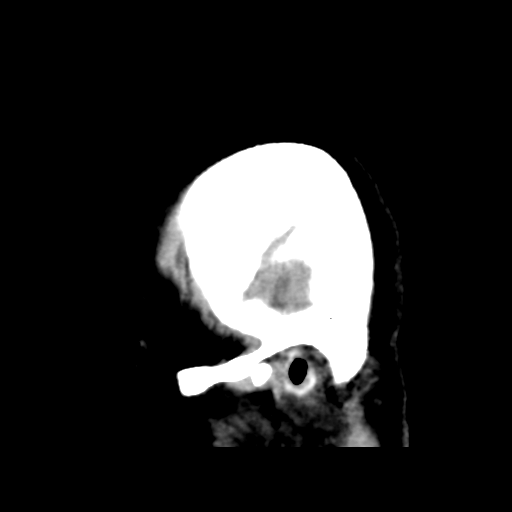 Cerebral metastasis to basal ganglia (Radiopaedia 81568-95412 E 53).png