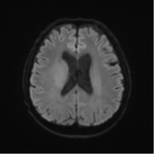 File:Cerebral toxoplasmosis (Radiopaedia 54575-60804 Axial DWI 53).png