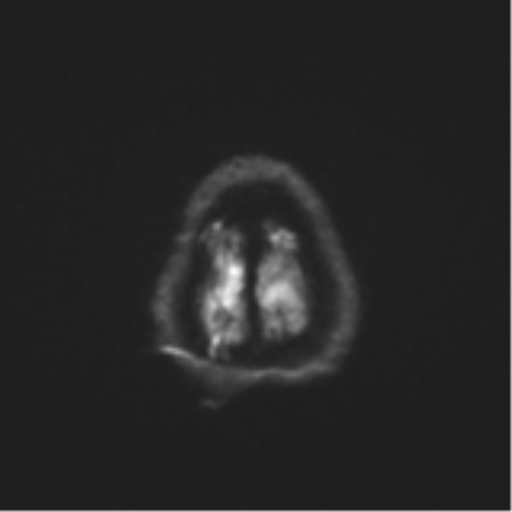 Cerebral toxoplasmosis (Radiopaedia 54575-60804 Axial DWI 62).png