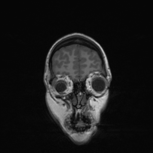 Cerebral tuberculosis with dural sinus invasion (Radiopaedia 60353-68090 Coronal T1 34).jpg