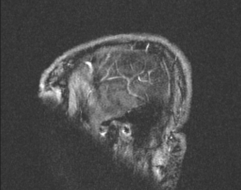 Cerebral venous infarction (Radiopaedia 65166-74176 Sagittal TOF 67).jpg