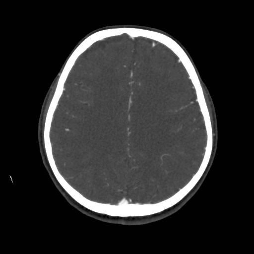Cerebral venous sinus thrombosis (Radiopaedia 40619-43227 A 154).jpg