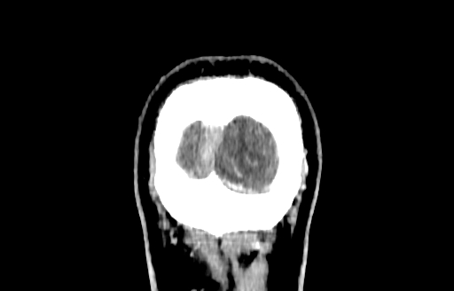 Cerebral venous thrombosis (CVT) (Radiopaedia 77524-89685 C 65).jpg