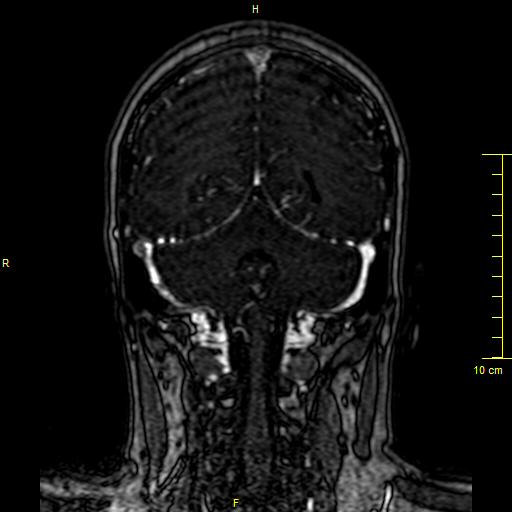Cerebral venous thrombosis (Radiopaedia 23288-23351 MRV 119).JPG