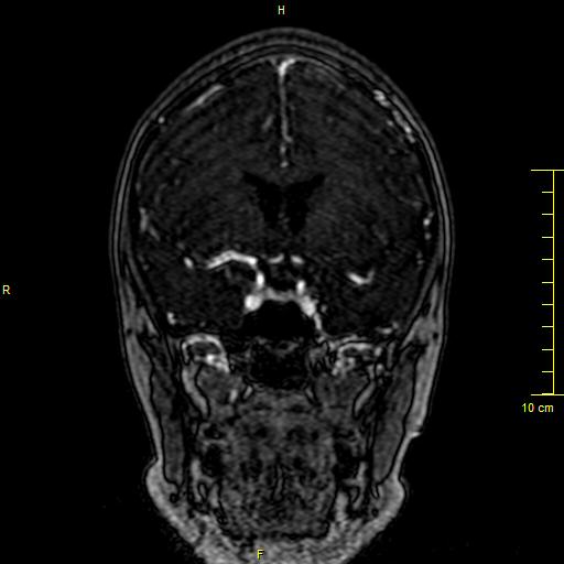 Cerebral venous thrombosis (Radiopaedia 23288-23351 MRV 49).JPG
