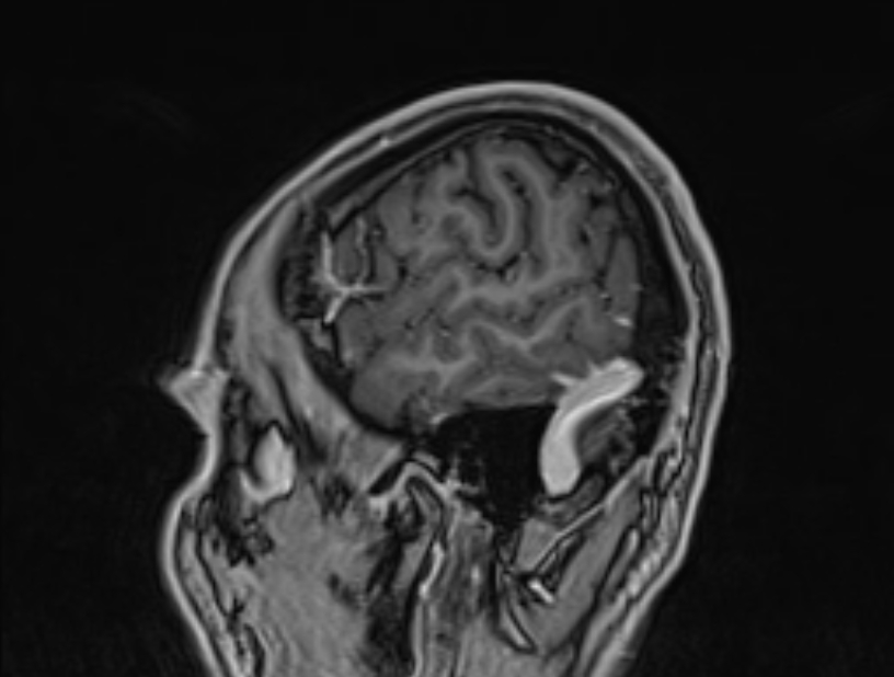 Cerebral venous thrombosis (Radiopaedia 71207-81504 Sagittal T1 C+ 5).jpg