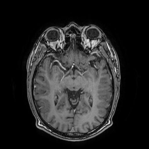 File:Cerebral venous thrombosis with secondary intracranial hypertension (Radiopaedia 89842-106957 Axial T1 C+ 86).jpg