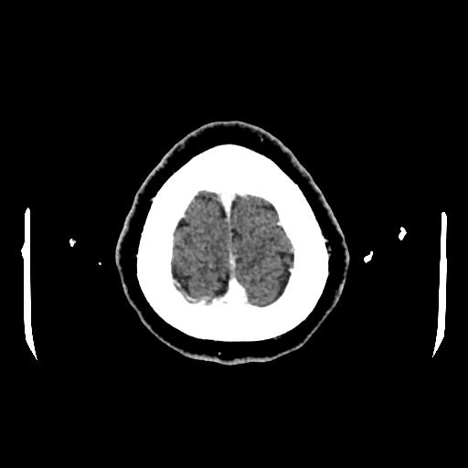 Cerebral venous thrombosis with venous hemorrhagic infarct (Radiopaedia 90354-107660 Axial with contrast 156).jpg