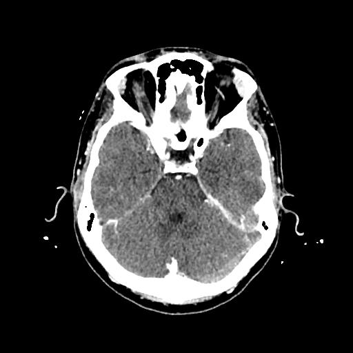Cerebral venous thrombosis with venous hemorrhagic infarct (Radiopaedia 90354-107660 Axial with contrast 56).jpg
