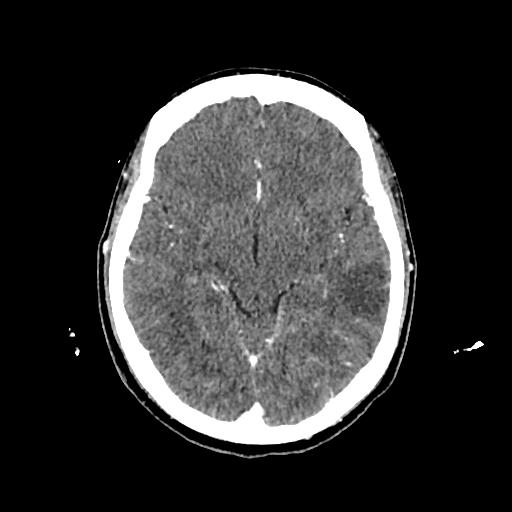 Cerebral venous thrombosis with venous hemorrhagic infarct (Radiopaedia 90354-107660 Axial with contrast 75).jpg