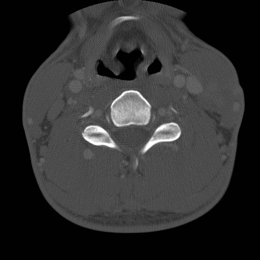 Cervical Pott disease (Radiopaedia 20374-20286 Axial bone window 88).jpg