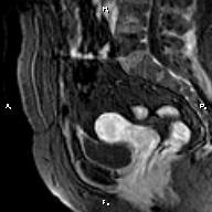 File:Cervical adenocarcinoma (Radiopaedia 65011-73985 E 21).jpg