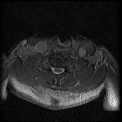 Cervical canal stenosis with cord compression (Radiopaedia 34114-35374 Axial Gradient Echo 30).png