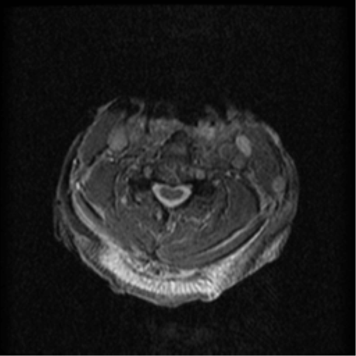 Cervical canal stenosis with cord compression (Radiopaedia 34114-35374 Axial Gradient Echo 48).png