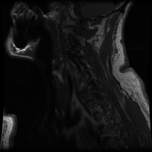 File:Cervical canal stenosis with cord compression (Radiopaedia 34114-35374 Sagittal T1 11).png