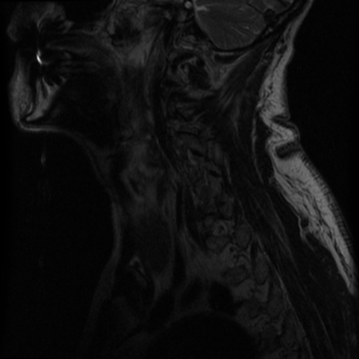 File:Cervical canal stenosis with cord compression (Radiopaedia 34114-35374 Sagittal T2 1).png