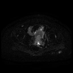Cervical carcinoma (Radiopaedia 85405-101028 Axial DWI 29).jpg