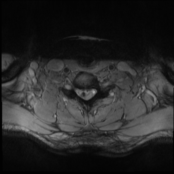 File:Cervical disc extrusion (Radiopaedia 53950-60077 Axial T2 26).jpg