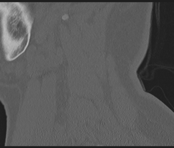 File:Cervical disc replacement (Radiopaedia 44025-47541 Sagittal bone window 13).png