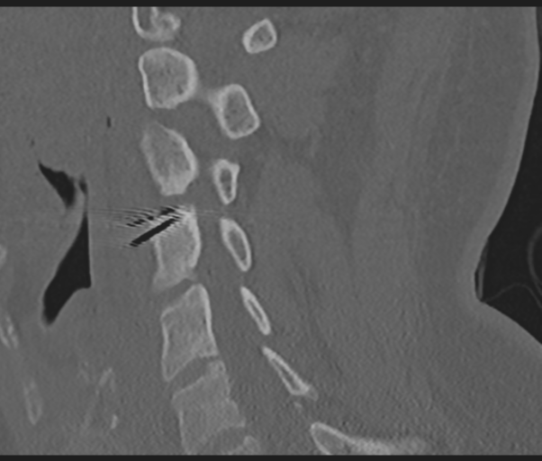Cervical disc replacement (Radiopaedia 44025-47541 Sagittal bone window 36).png
