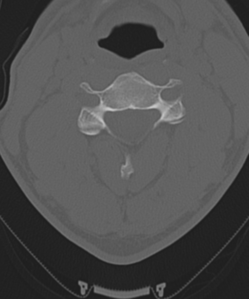 Cervical intercalary bone (Radiopaedia 35211-36748 Axial bone window 30).png