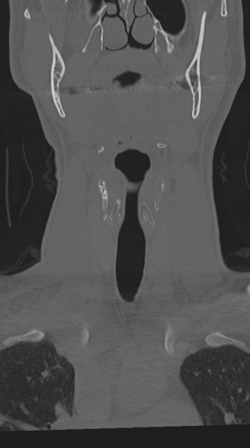 Cervical intercalary bone (Radiopaedia 35211-36748 Coronal bone window 13).png