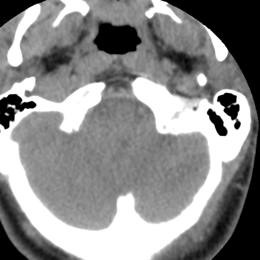 Cervical schwannoma (Radiopaedia 57979-64974 Axial non-contrast 10).png