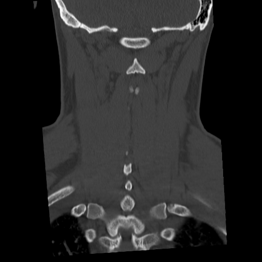 Cervical schwannoma (Radiopaedia 57979-64974 Coronal bone window 43).png