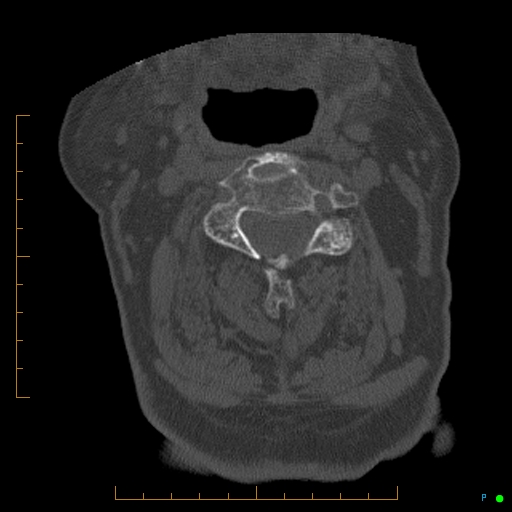 File:Cervical spine fracture - ankylosing spondylitis (Radiopaedia 76835-88706 Axial bone window 85).jpg