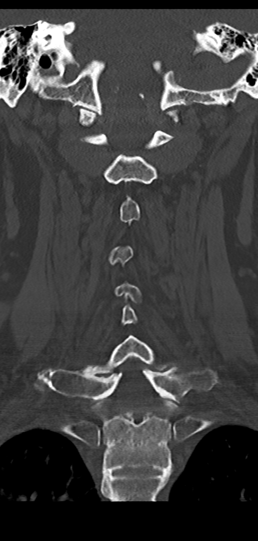 Cervical spine fracture - chalk stick (Radiopaedia 39116-41323 Coronal bone window 32).png
