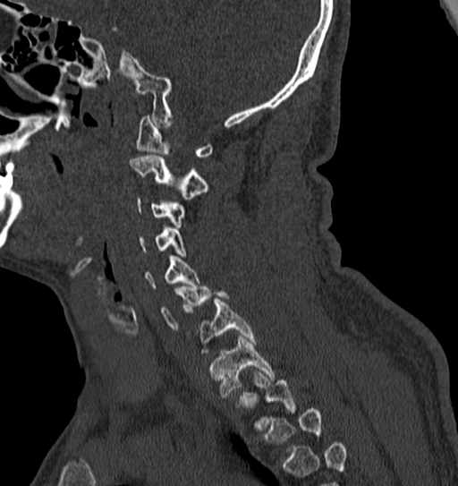 Cervical spine trauma with tear drop fracture and perched facet joint (Radiopaedia 53989-60127 Sagittal bone window 116).jpg