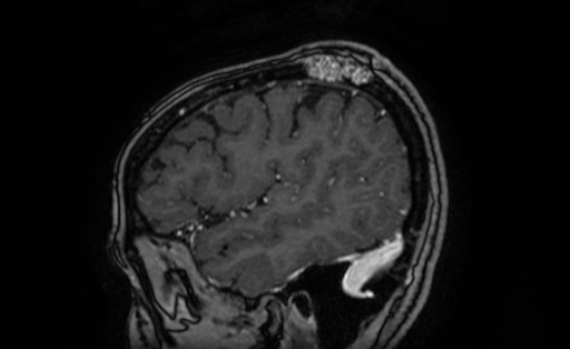 Cervical spondylodiscitis and calvarial hemangioma (Radiopaedia 64317-73103 Sagittal T1 C+ 12).jpg