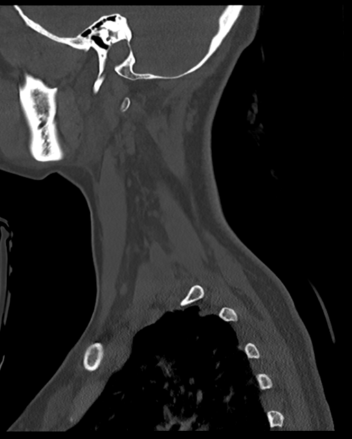 Cervical tuberculous spondylitis (Radiopaedia 39149-41365 Sagittal bone window 59).png