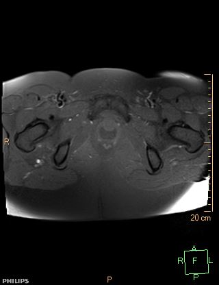 File:Cesarian scar endometriosis (Radiopaedia 68495-78066 Axial T1 fat sat 23).jpg