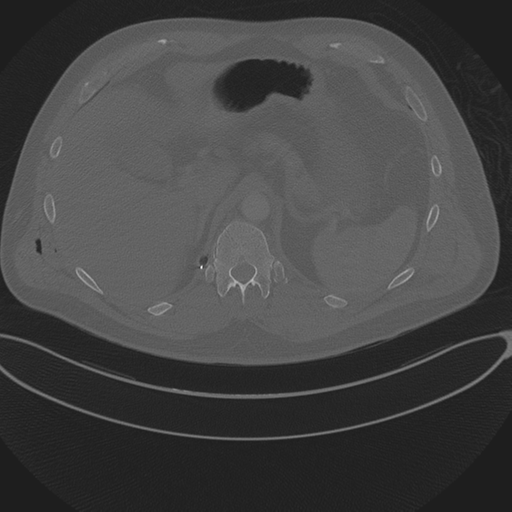 Chest multitrauma - aortic injury (Radiopaedia 34708-36147 Axial bone window 288).png