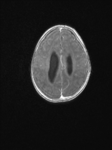 Chiari III malformation with occipital encephalocele (Radiopaedia 79446-92559 Axial T1 C+ mpr 64).jpg