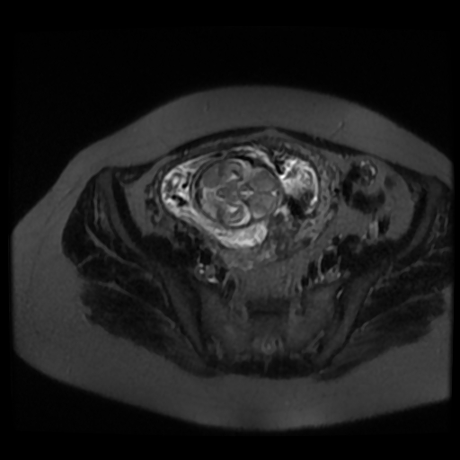Chiari II malformation - fetal MRI (Radiopaedia 68099-77581 Axial T2-SSFSE 41).jpg