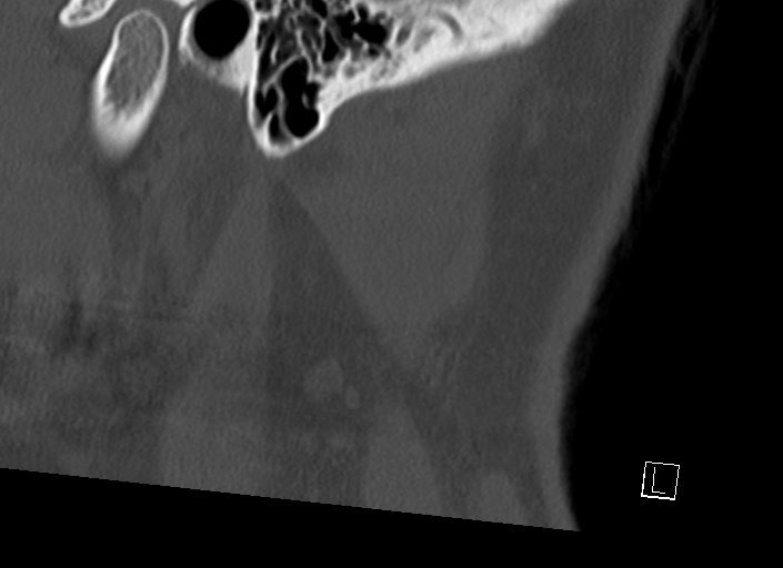 Chiari I malformation with a symptomatic syrinx of the posterolateral medulla oblongata (Radiopaedia 42573-45707 A 3).jpg