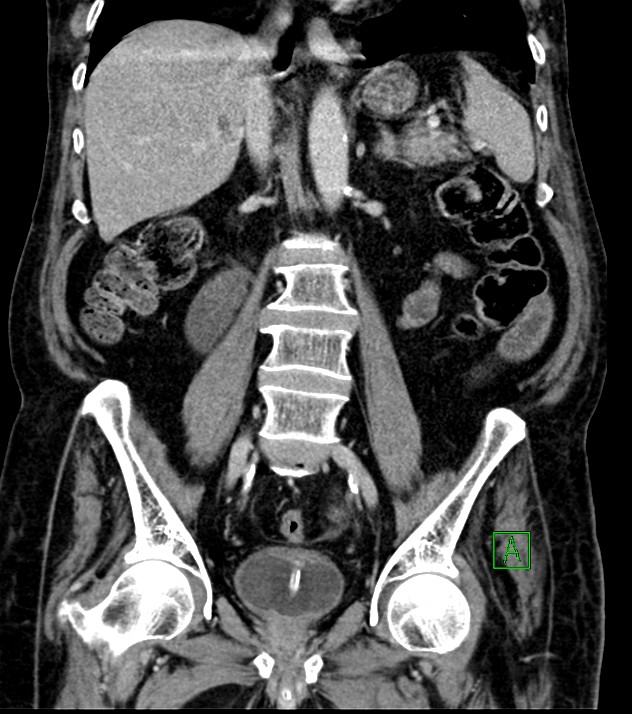 Cholangiocarcinoma with cerebral metastases (Radiopaedia 83519-98629 G 47).jpg