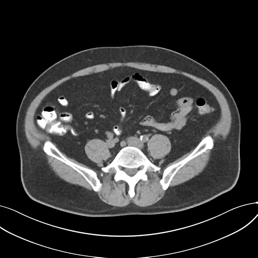 File:Cholecystitis with focal perforation and hepatic abscess (Radiopaedia 37189-38945 Axial non-contrast 58).png