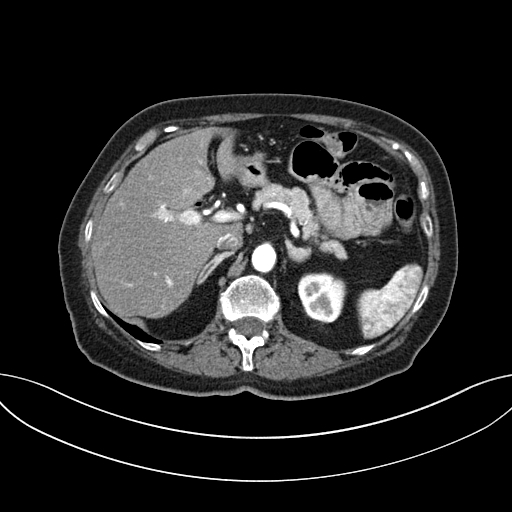 Cholecystoduodenal fistula due to calculous cholecystitis with gallstone migration (Radiopaedia 86875-103077 A 22).jpg
