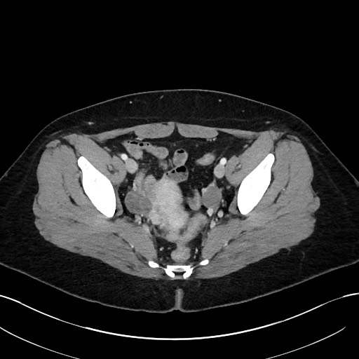 File:Choledocholithiasis after recent cholecystectomy (Radiopaedia 60929-68737 Axial 46).jpg