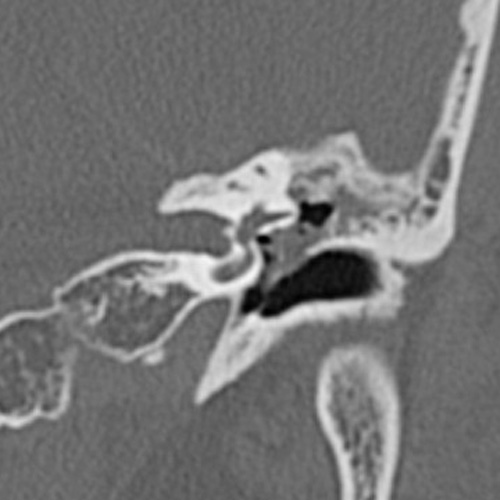 File:Cholesteatoma (Radiopaedia 9408-10093 Coronal bone window 8).jpg